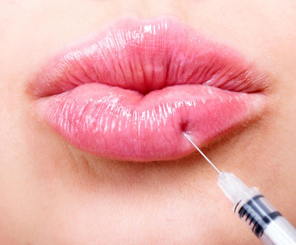 Lip Filler