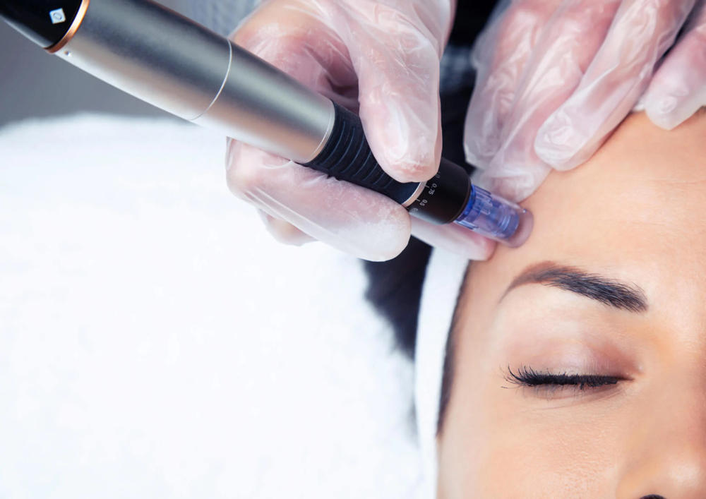 Microneedle Facial