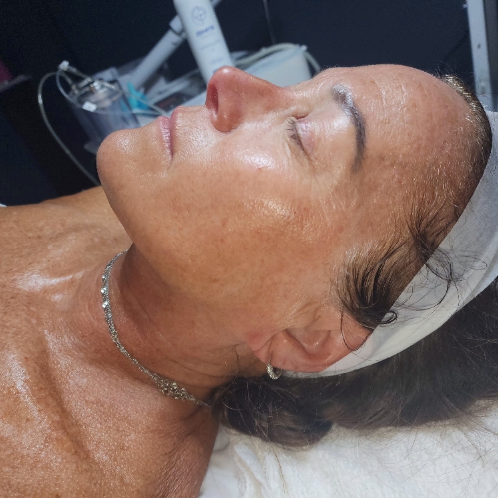 Hydro Microdermabrasion Facial at Celtic Spa Laser Services in Attleboro, MA