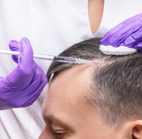 Microneedling for Hair Restoration