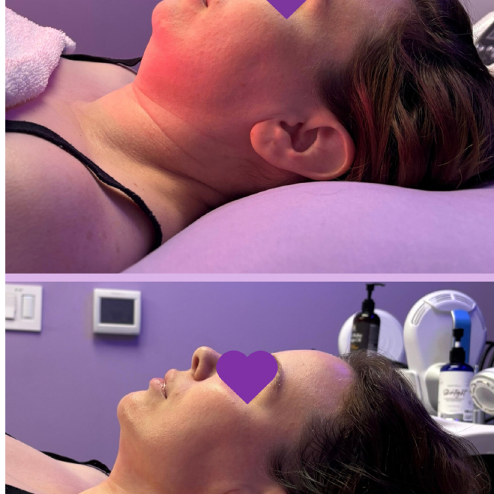Sculpted Chin Package at Divinity Essence Spa in Winter Springs, FL
