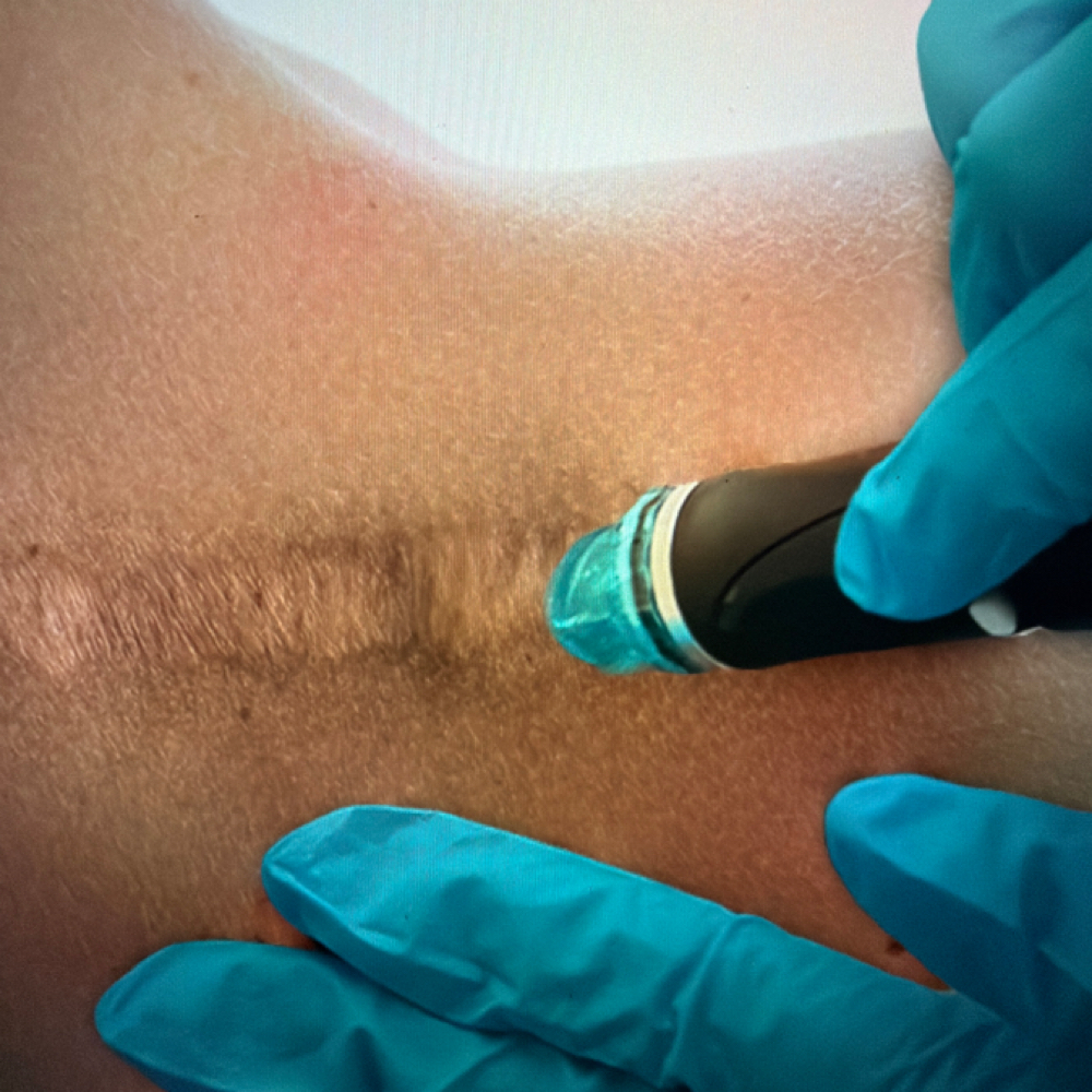 Scar Rejuvenation at Cherlyn Deleonabreu “Perfectly You” in Liverpool, NY
