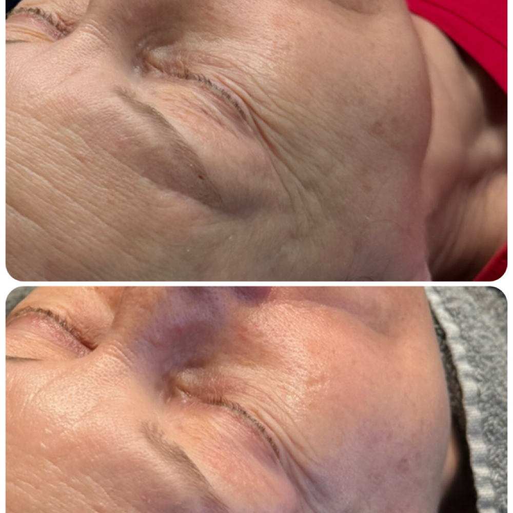HydraFacial Perk Eye | Precision Ey at Elevate by Arline Transformational Skin & Effortless Beauty in Cedar Park, TX