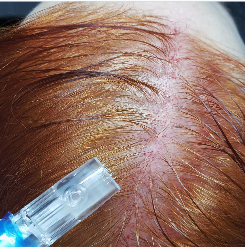 Scalp Micro Needling