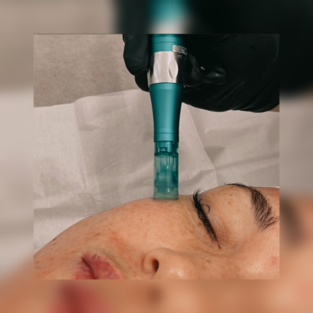 Microneedling