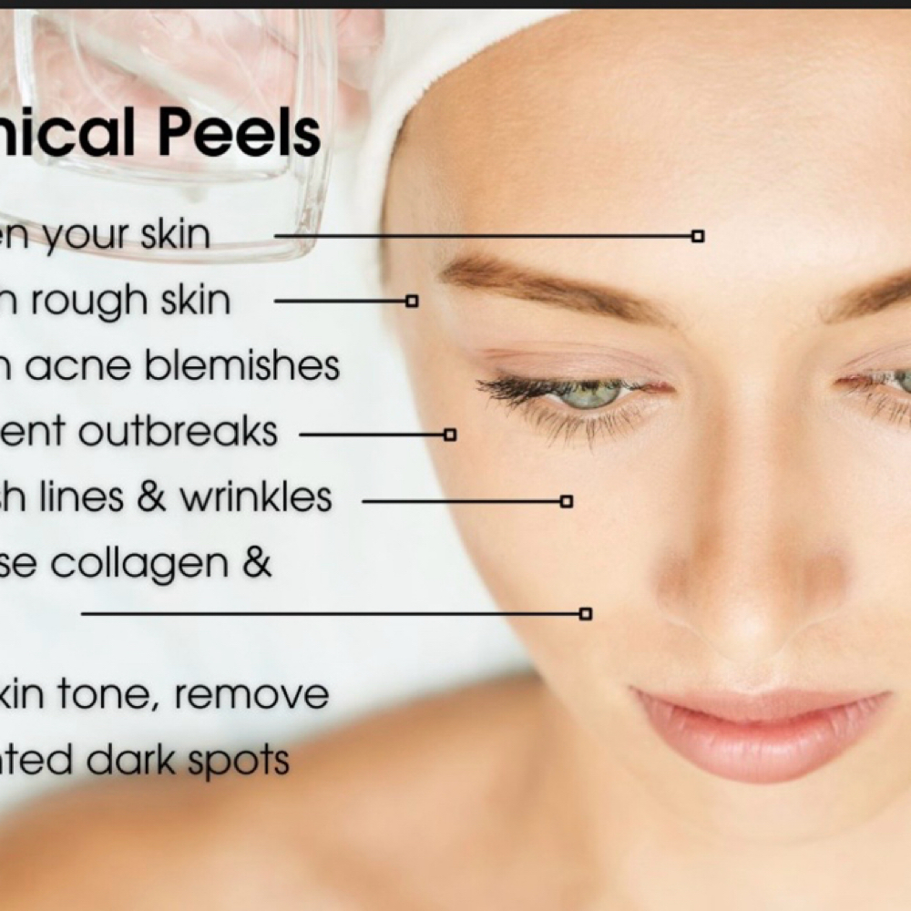 Power Peel at SkinSoFine1 in TEXAS, TX