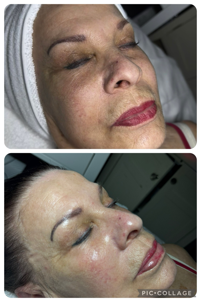 Anti-aging facial treatment