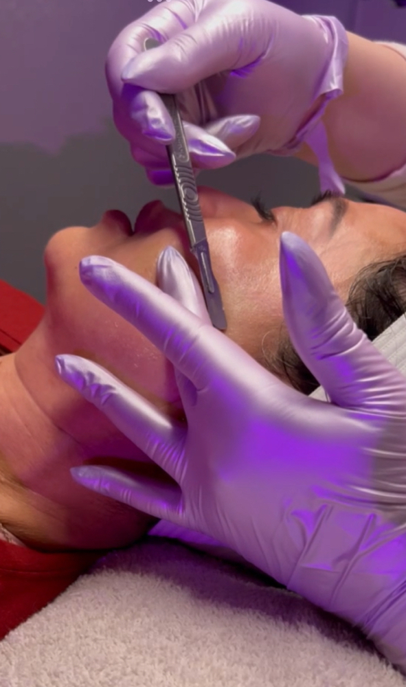 Dermaplaning