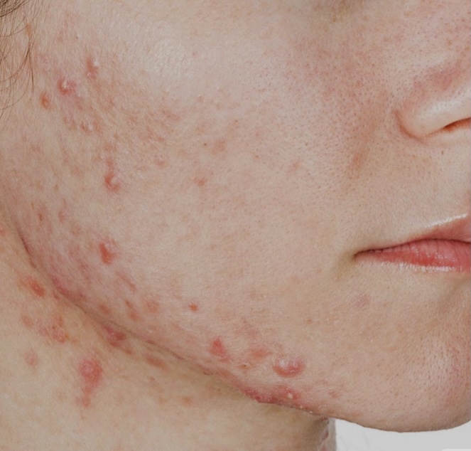 Cystic Acne Treatment