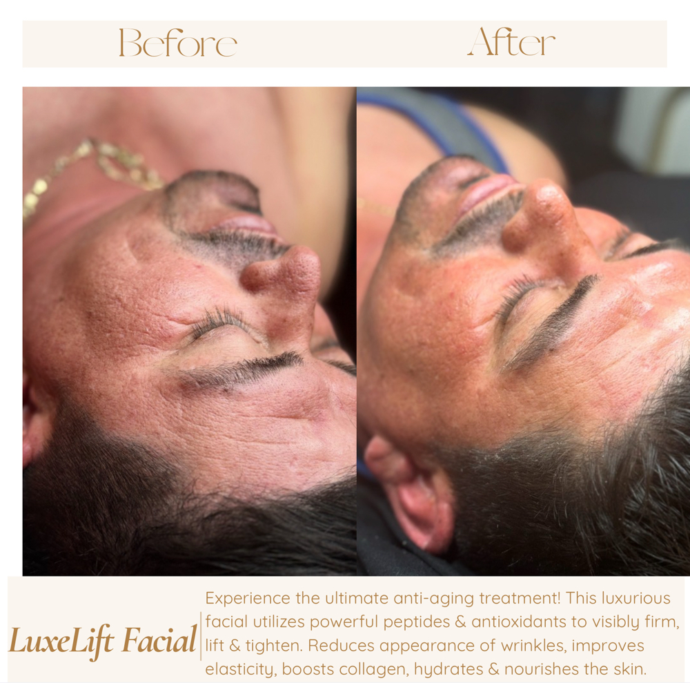 LuxeLift Facial