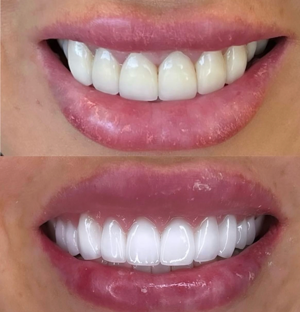 Teeth Whitening 60 Minutes