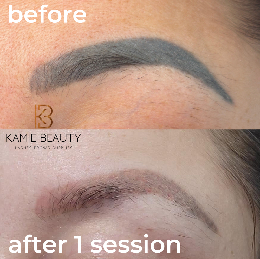 TOUCH UP BROWS REMOVAL LASER