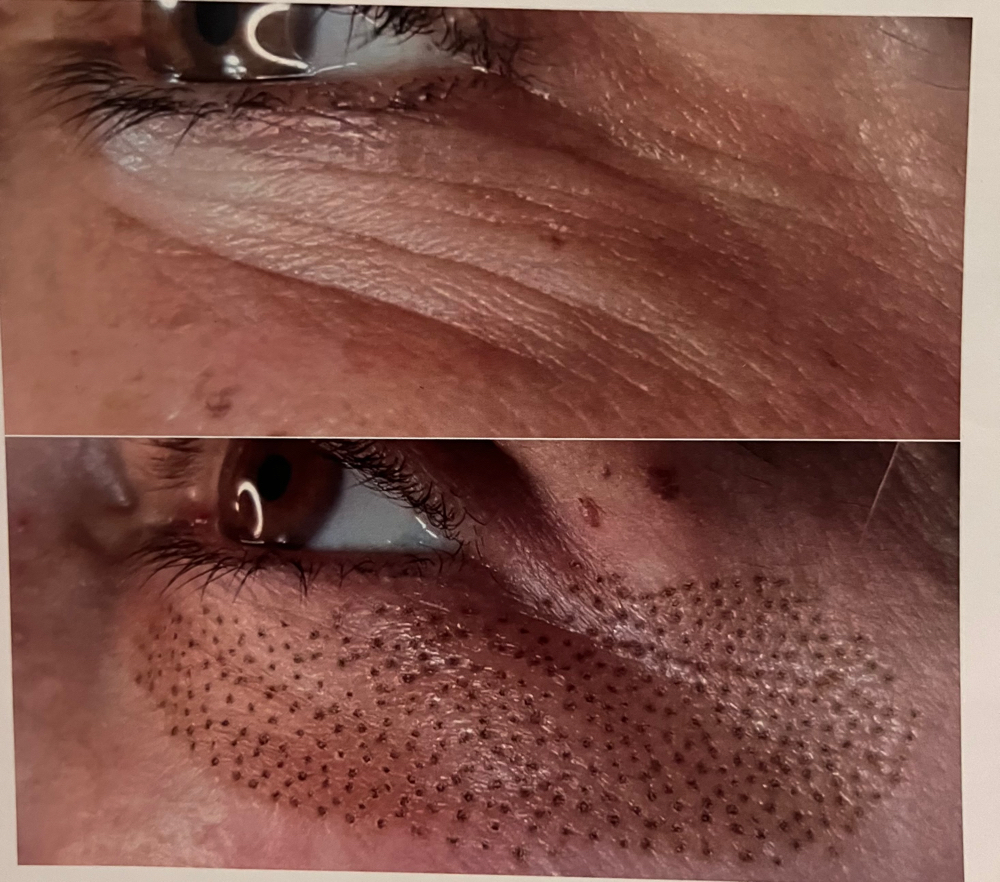 Plasma Fibroblast Lower Eyelids