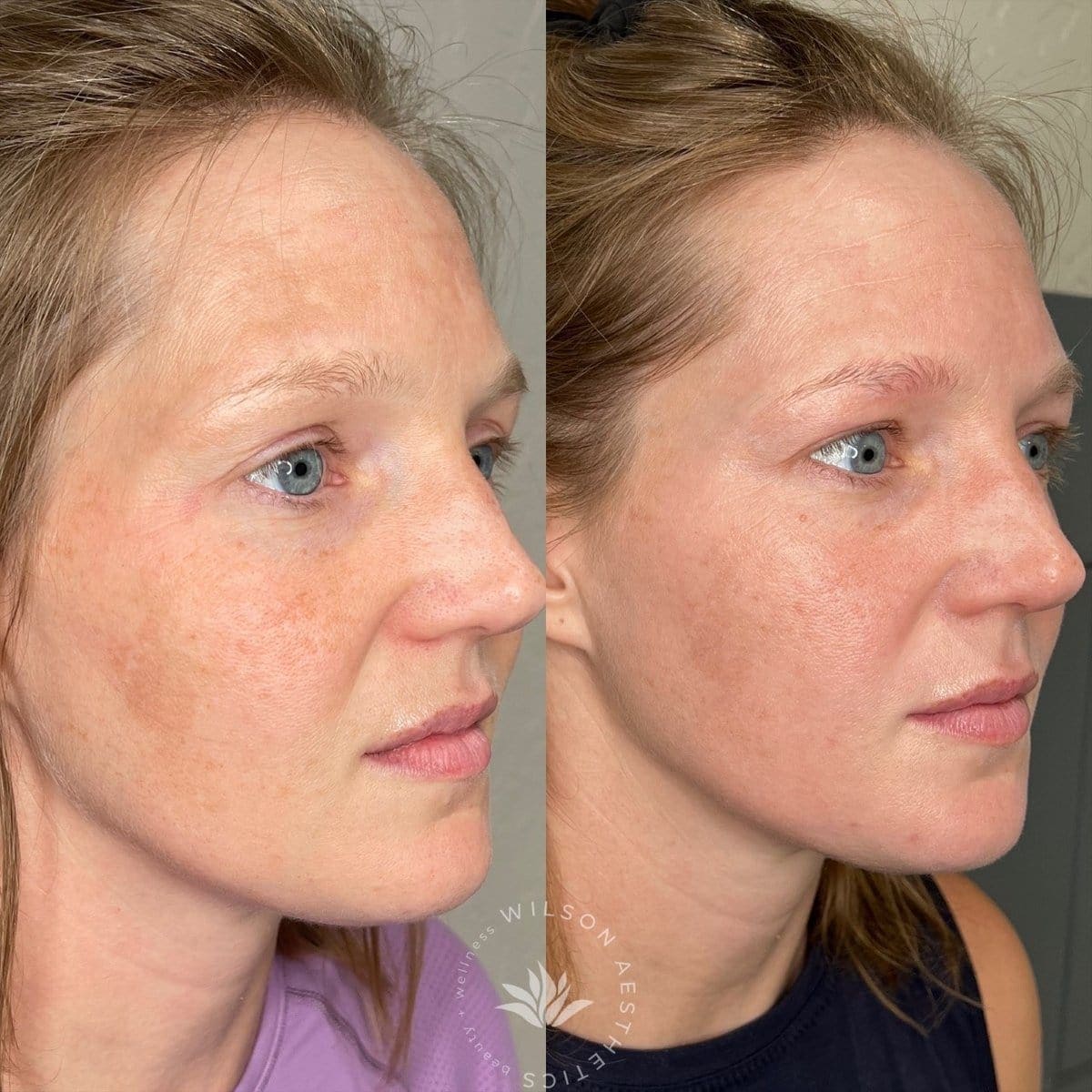 Custom Chemical Peel