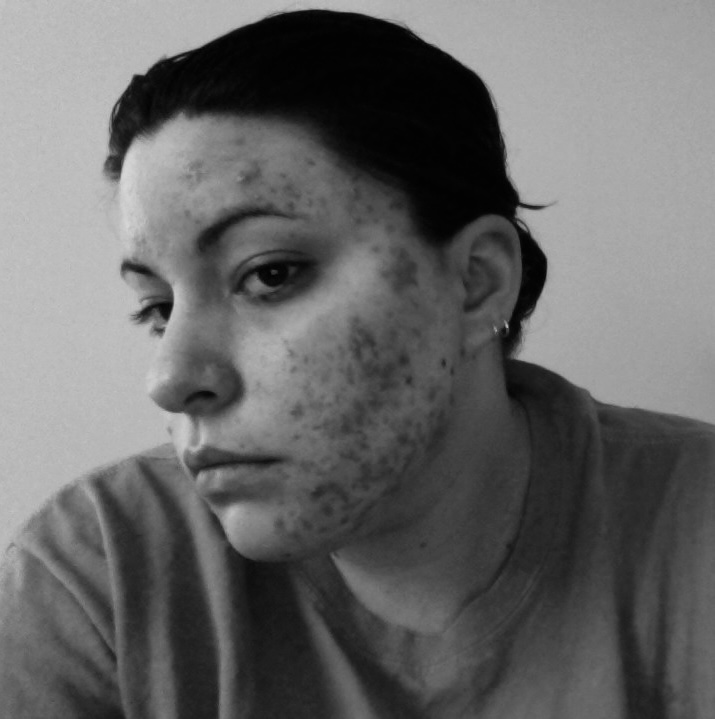 Clear Skin Facial