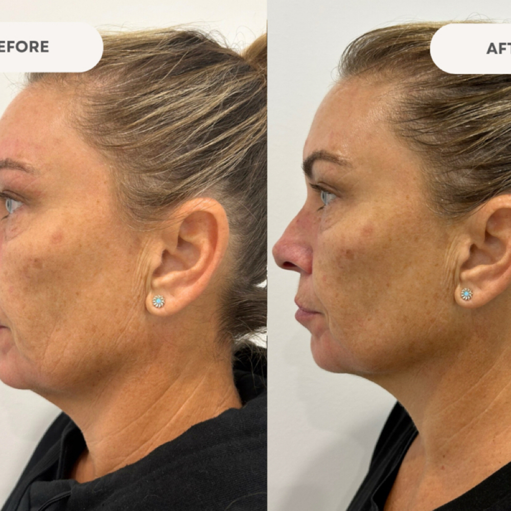 HIFU at ARock Beauty & Wellness in San Angelo, TX
