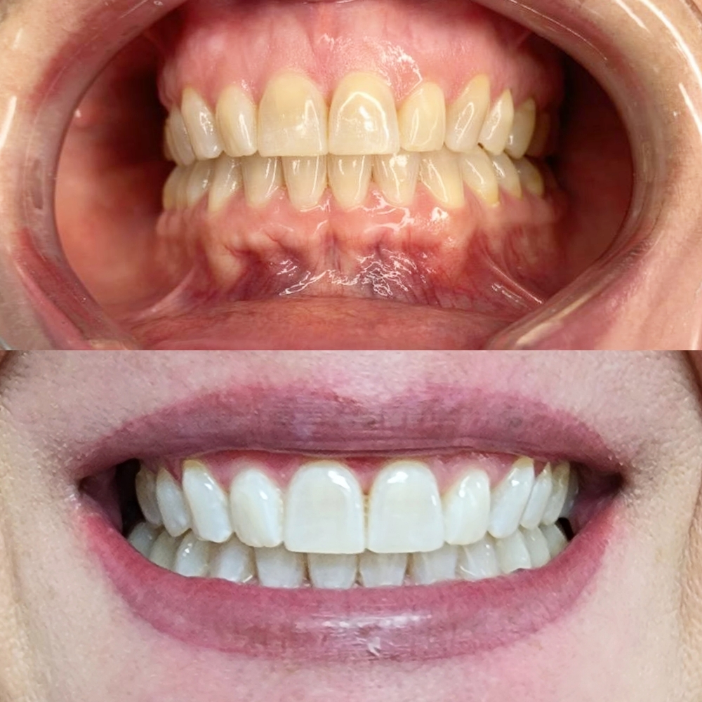 Teeth Whitening 60min Session