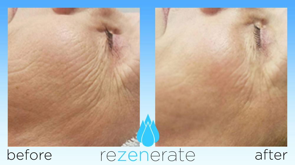 Rezenerate Nano Facial