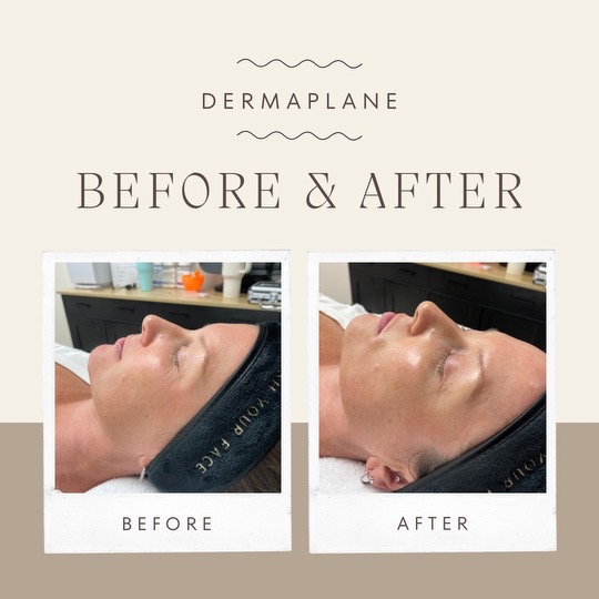 Dermaplaning Facial at Barevia in Tempe, AZ