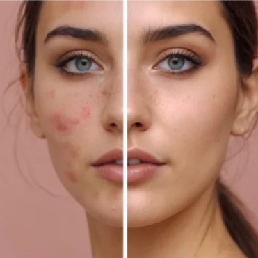 Face Reality Acne Treatment at Essential Esthetics Spa, LLC in Parker, CO