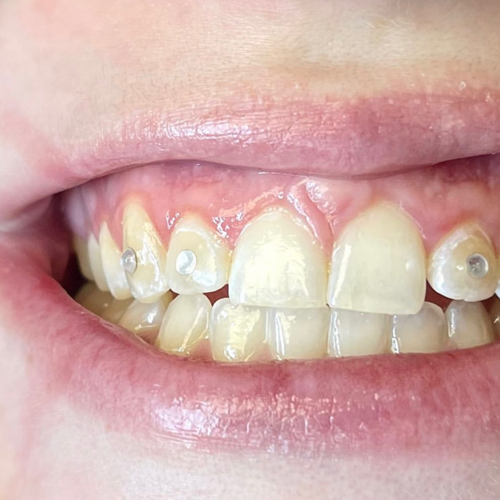 Multi Tooth Gem