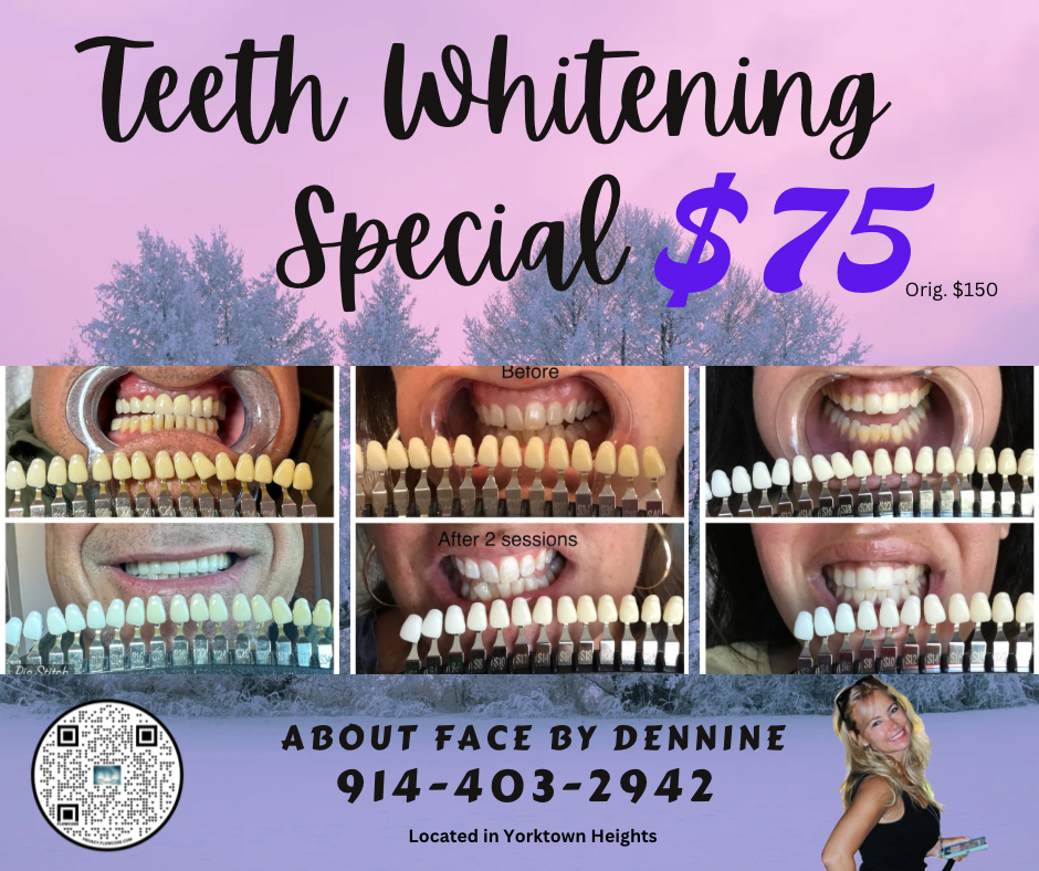 50% Off Teeth Whitening (orig 150)