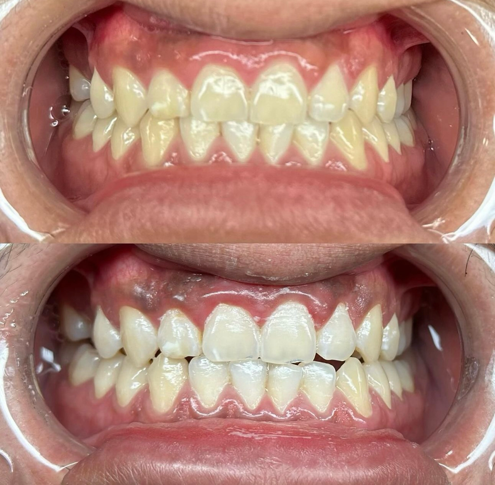 🦷60min Teeth Whitening Session