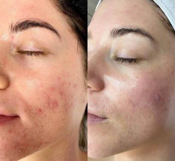 Her. Dew Drop & microdermabrasion