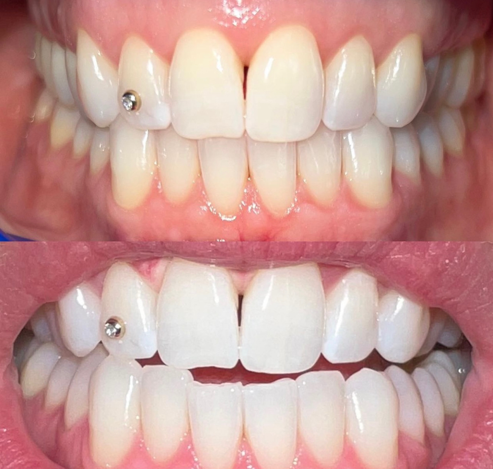 Teeth Whitening (1)🪥