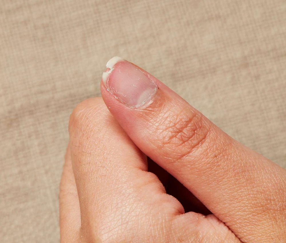 Nail Repair at Anji West in McEwen, TN