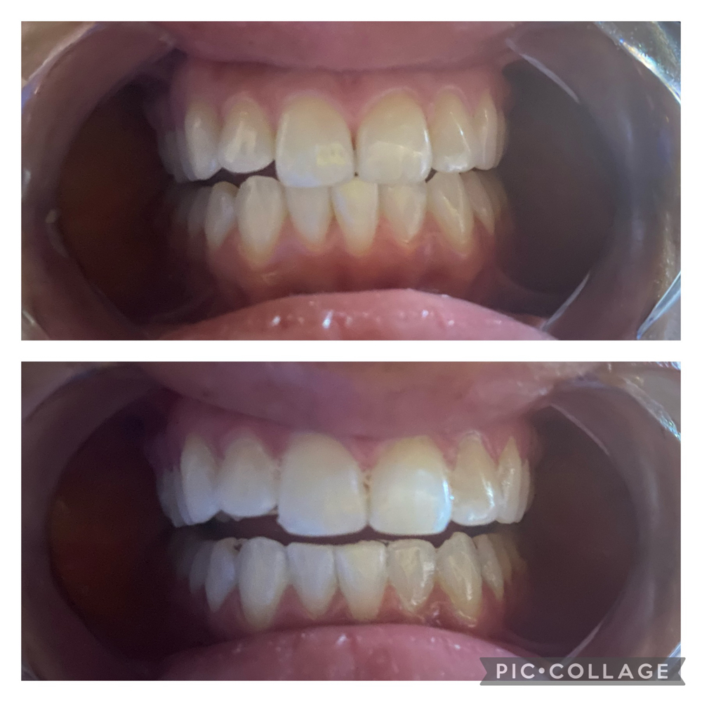 Teeth Whitening 90 Minutes