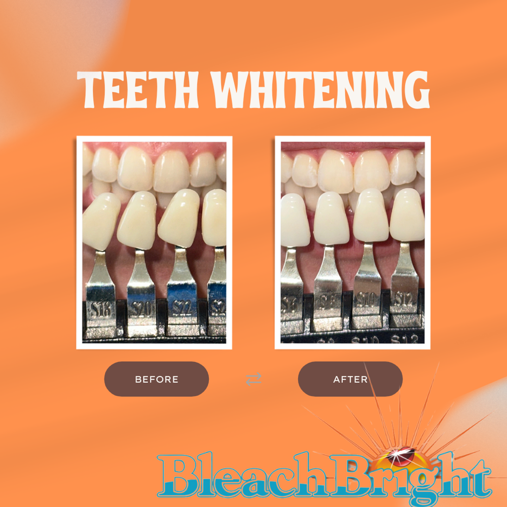 Teeth Whitening