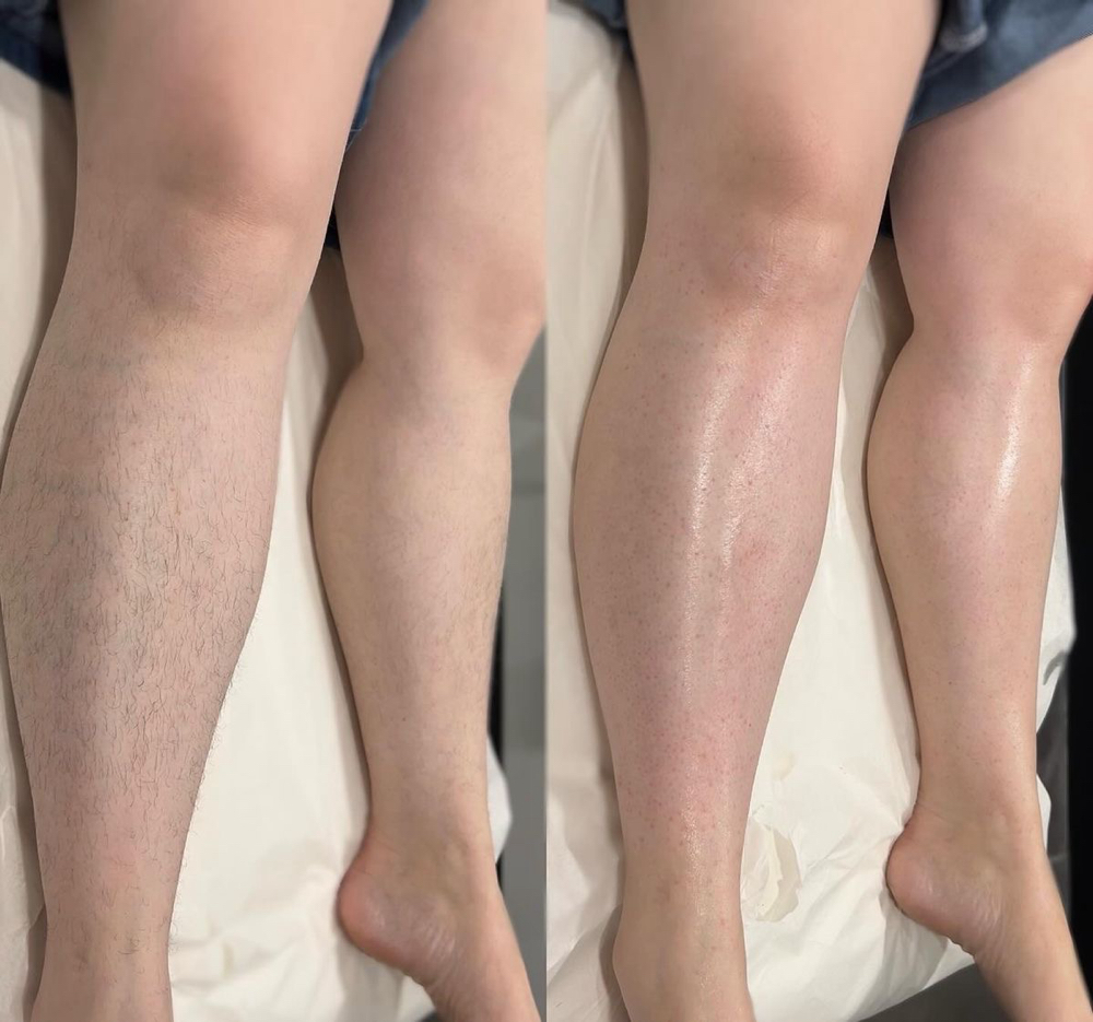 Full Leg Hair Removal at Yulee Mac Aesthetics in Tontitown, AR