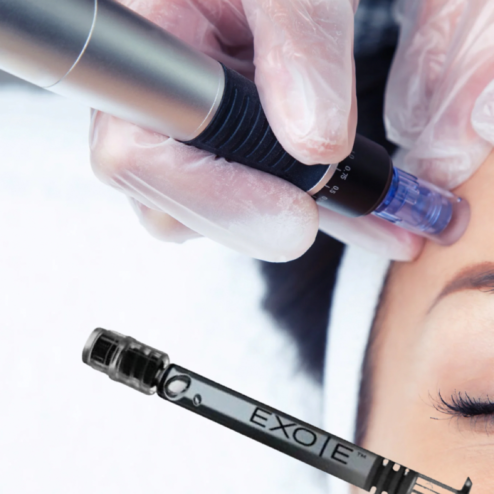 Microneedling With Exosomes at Pate Aesthetics in Morristown, TN