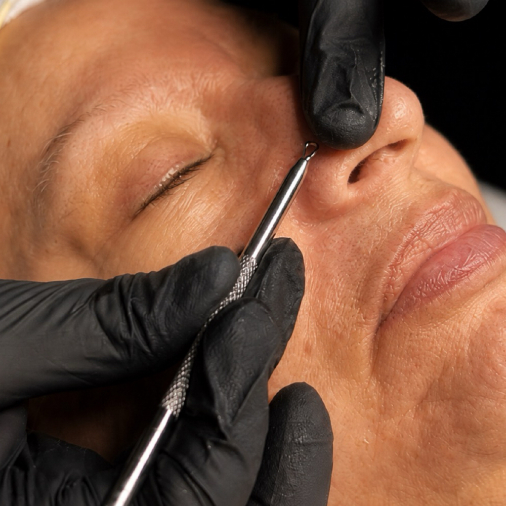 CYNN’S Acne Clarity Facial at CYNNSBEAUTY in Tustin, CA