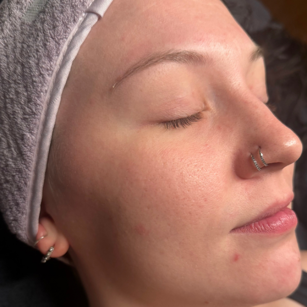 Anti-Blemish Spot Zap (Mini Facial) at Crue Esthetics in Kalispell, MT