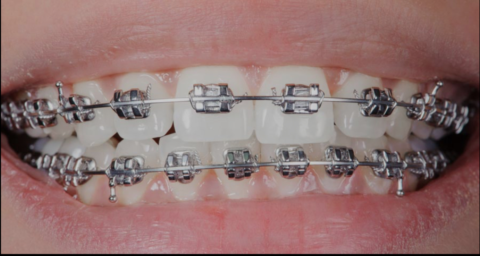 Ligature And Wire Change