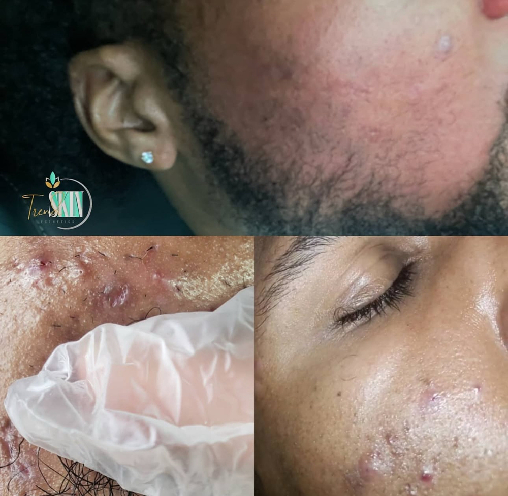 Acne Peel Treatments (2 Weeks)