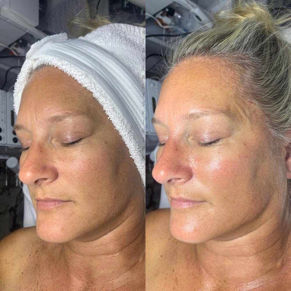 Advanced Facial