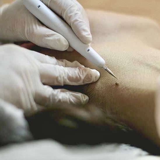 WART REMOVAL