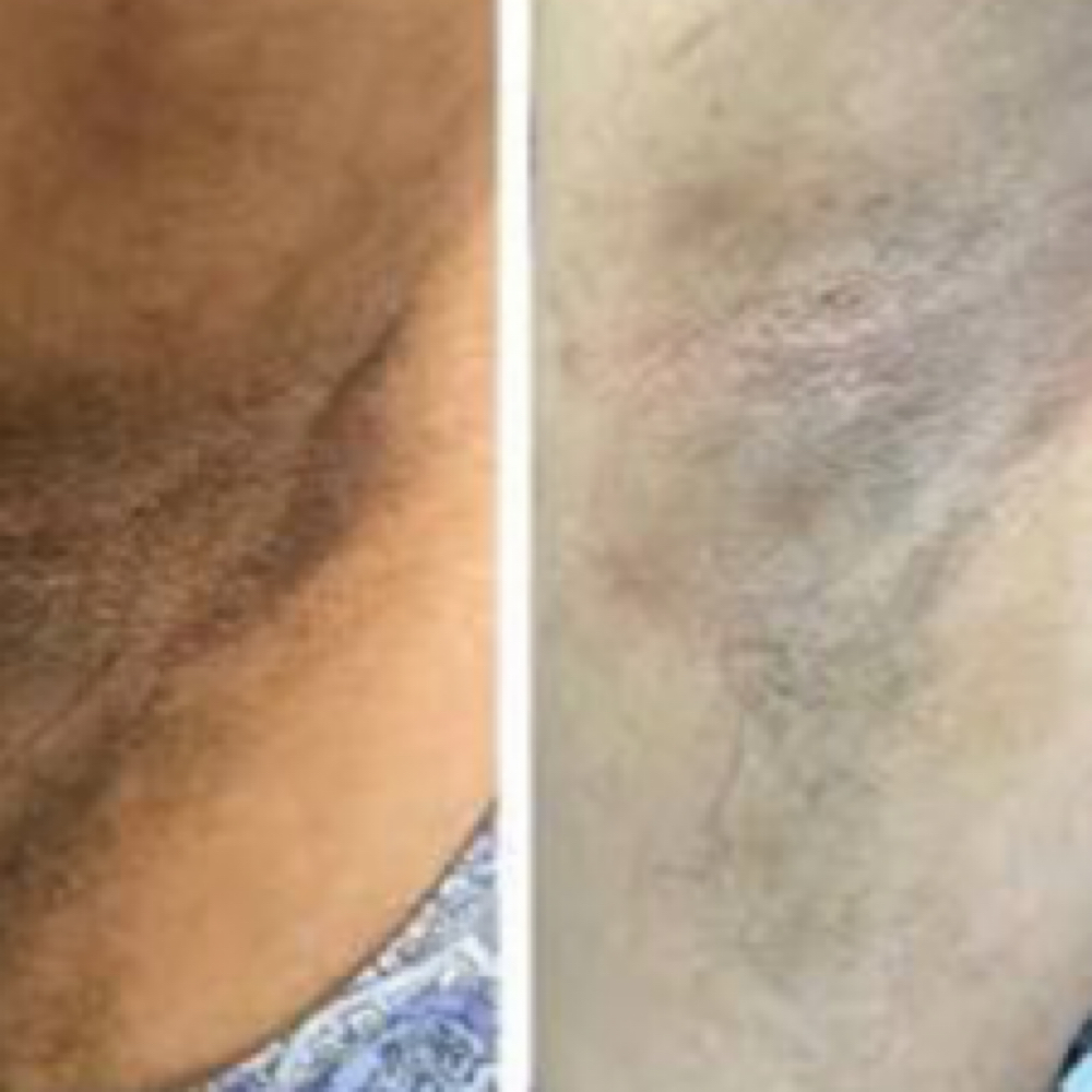 Underarm Brightening Treatment at Ana Aesthetic & Beauty in Freeport, NY