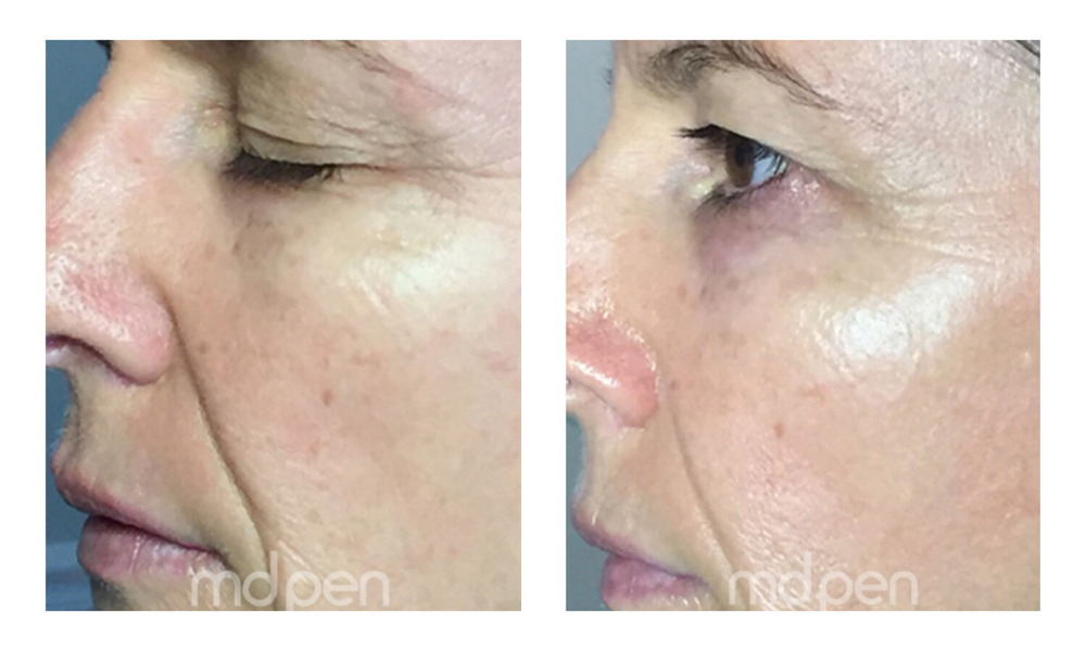 Micro Needling- Cheeks