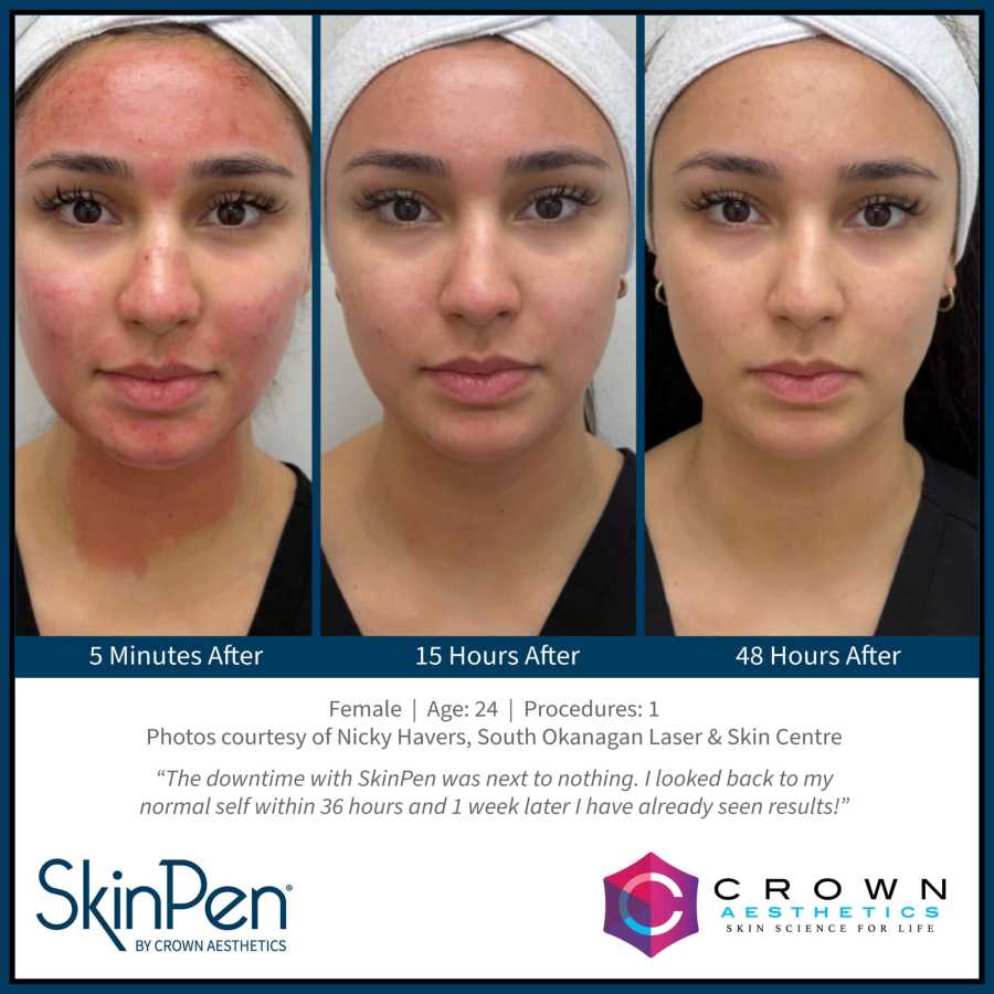 Microneedling Treatment