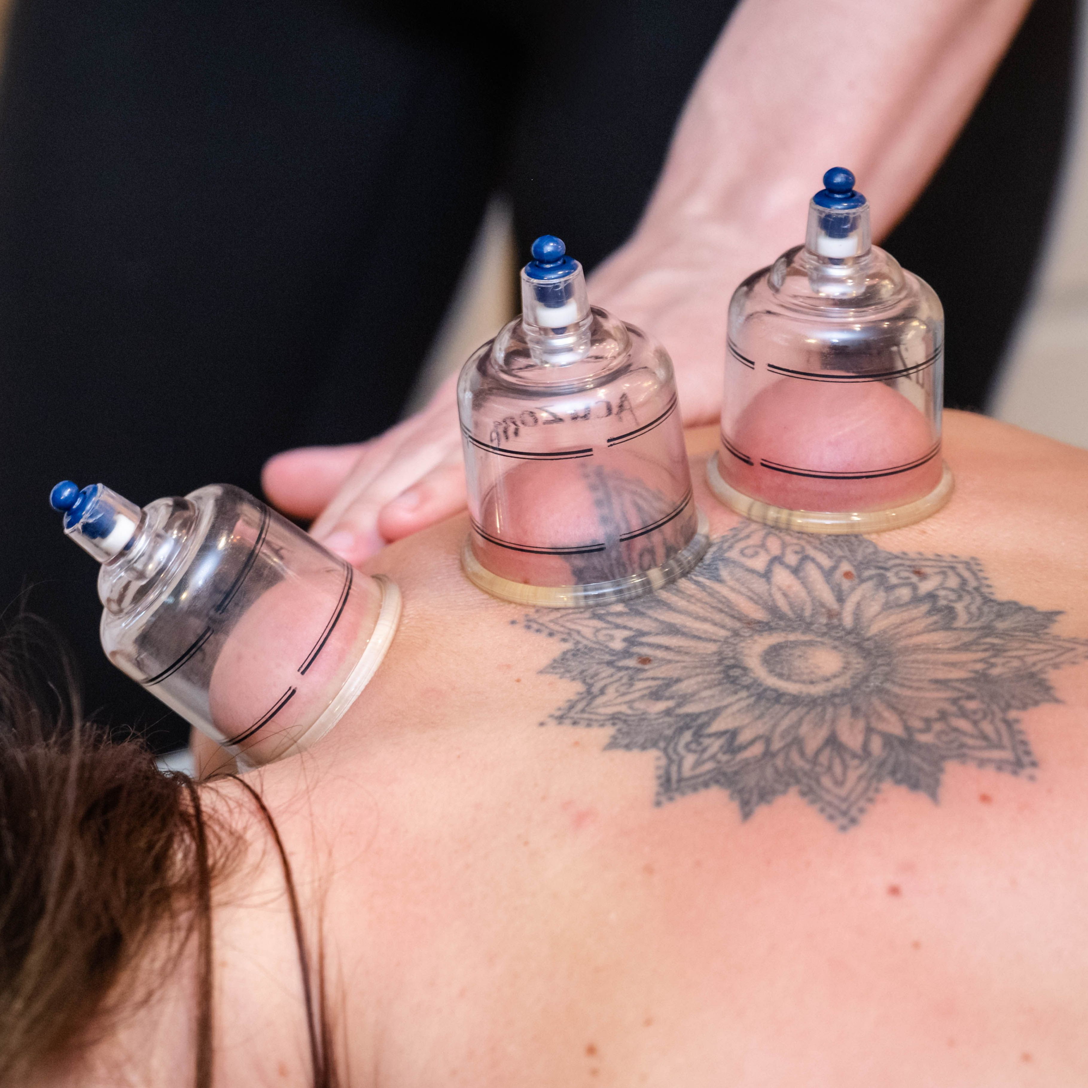 Cupping Therapy at Relax & Revive in Lakewood, CO
