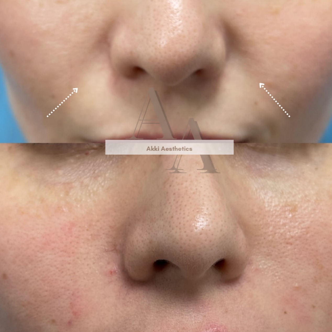 Nasolabial Folds ( Smile Lines) (ML at Akki Aesthetics in Williston Park, NY