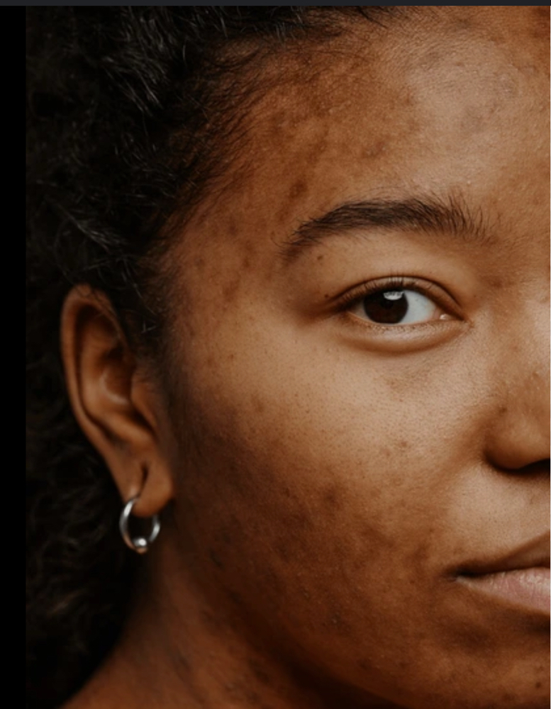 Teen Complexion Clearing Facial