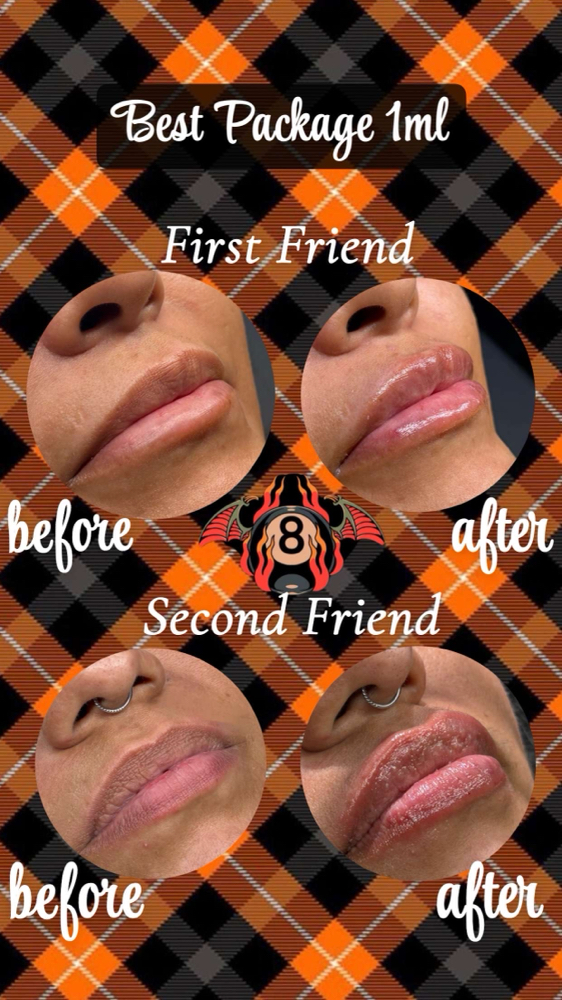 Bestie 1ml Package at Punchy Pouts & Esthetics in Amarillo, TX