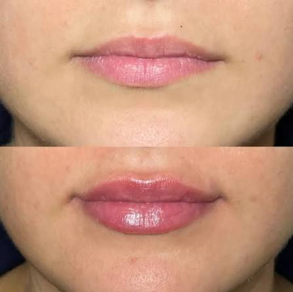Lip Flip at Studios Secrets in Dallas, TX