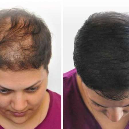 Scalp Micropigmentation at Integrative & Trichology Wellness in Charlotte, NC