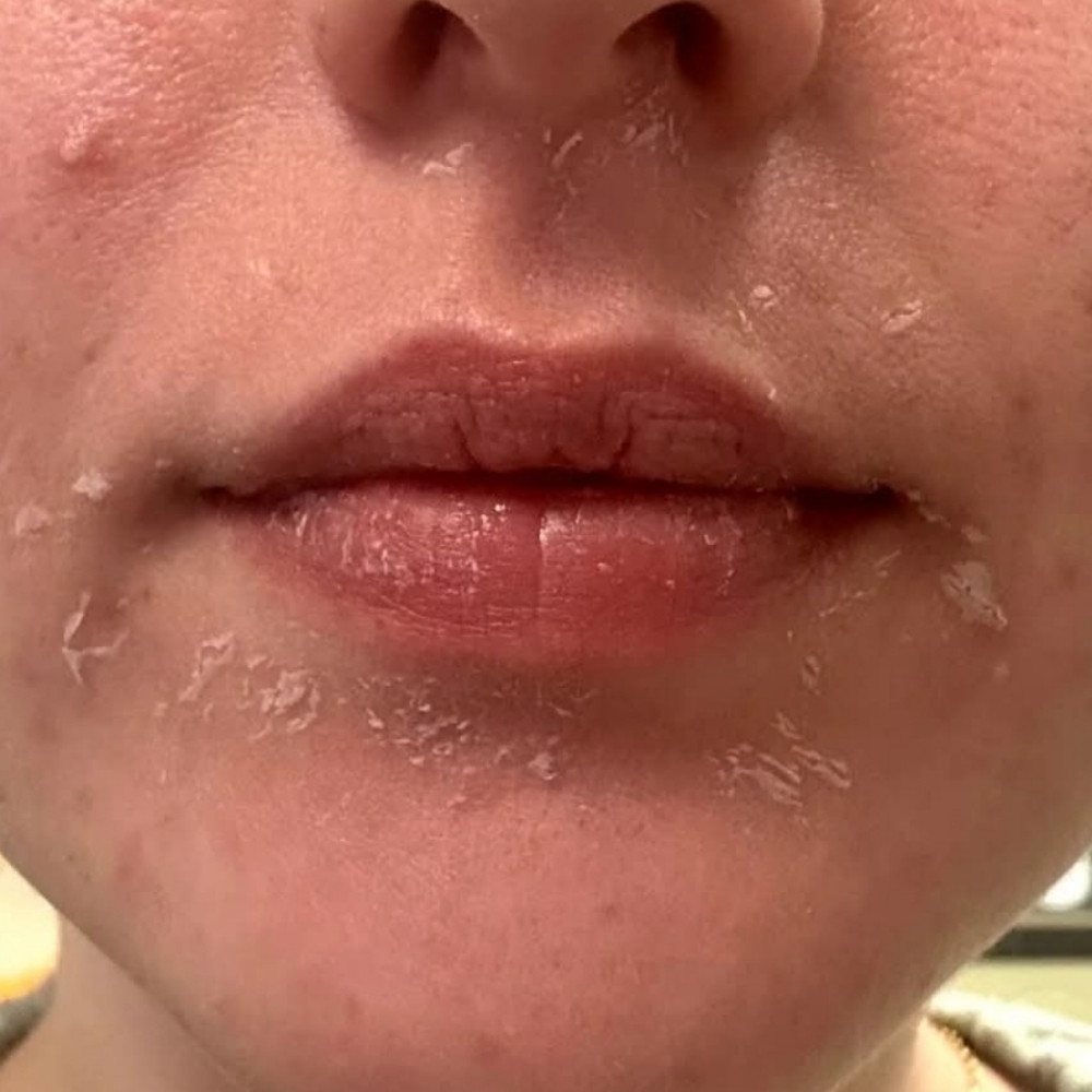 PCA Peels at Andrea Godsey in Mesa, AZ